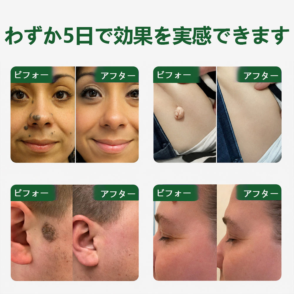 COLTURE® sim イボ・ほくろ除去マイクロニードルパッチ