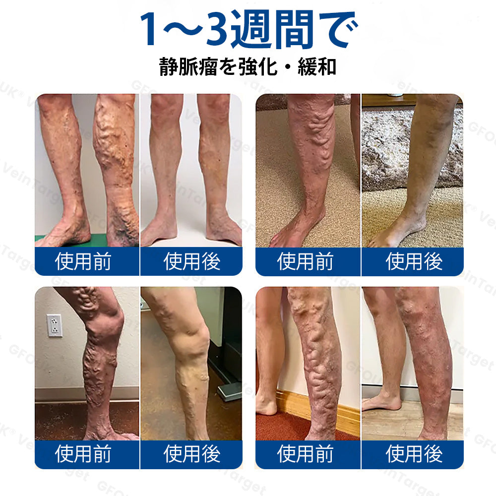 COLTURE® VeinTarget マイクロニードルパッチ⚡即効性、長期的な効果