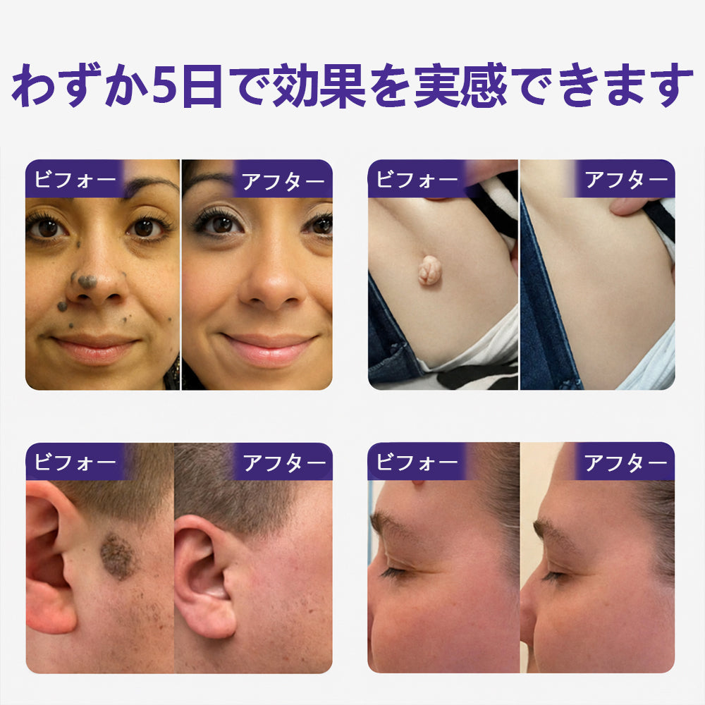 COLTURE® イボ・ほくろ除去マイクロニードルパッチ✨