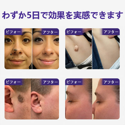 COLTURE® イボ・ほくろ除去マイクロニードルパッチ✨