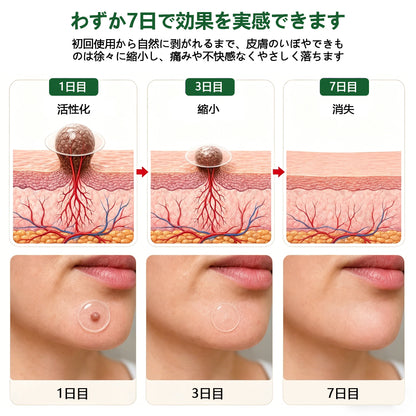 COLTURE® sim イボ・ほくろ除去マイクロニードルパッチ